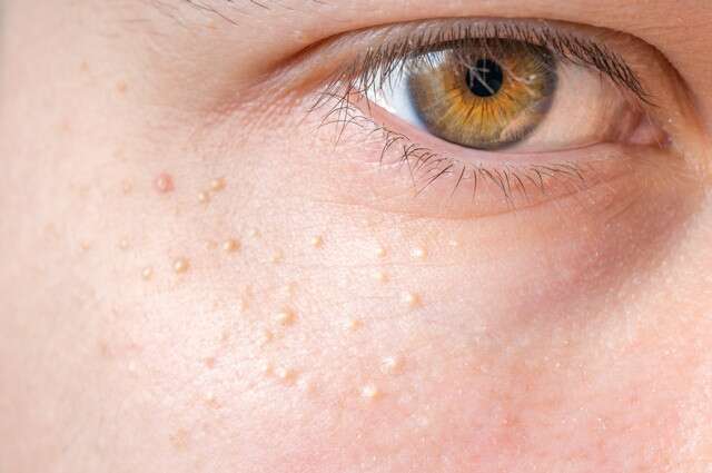 What Are White Pimples or Milia?