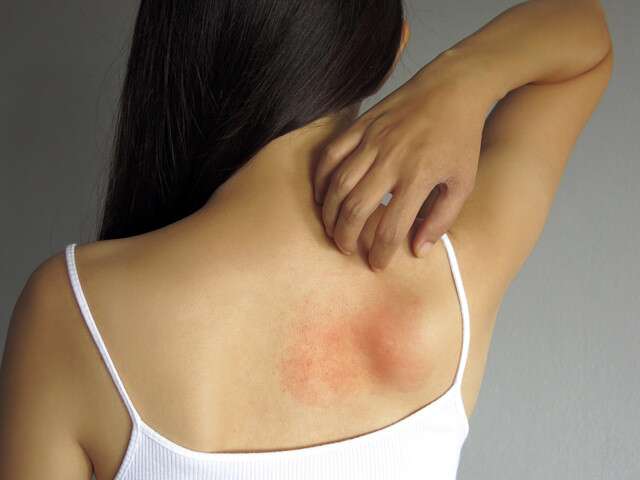 Las manchas rojas en la piel pueden significar sarpullido por calor