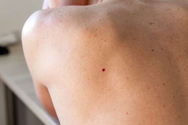 Las manchas rojas en la piel pueden significar angiomas de cereza