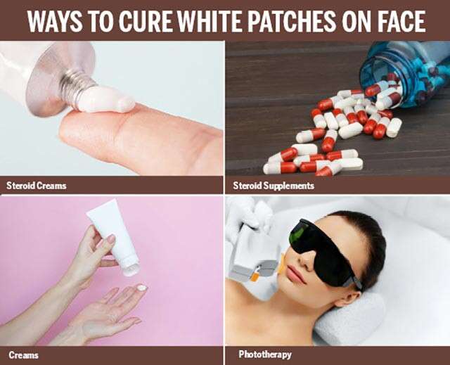 Infografía de remedios caseros para manchas blancas en la cara